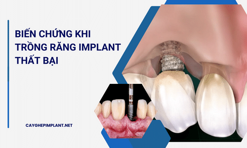 Những biến chứng khi trồng răng implant thất bại (Cách khắc phục)