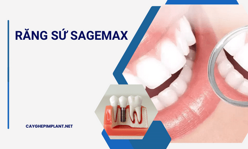 Răng sứ Sagemax là gì ? Có tốt không ?