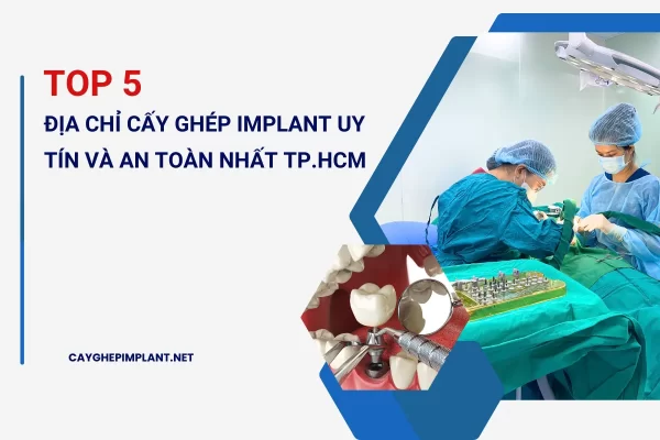 Top 5 Địa chỉ cấy ghép implant uy tin và an toàn tại TP.HCM