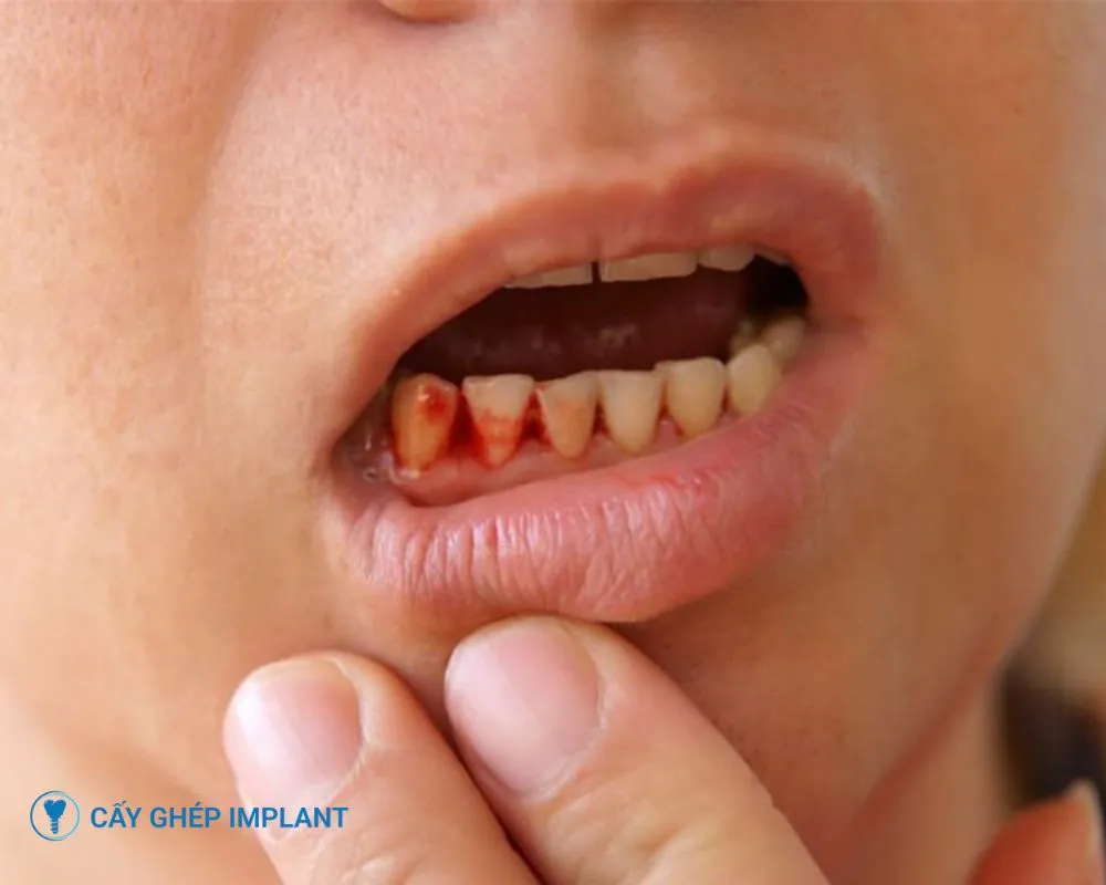 biến chứng khi trồng răng implant