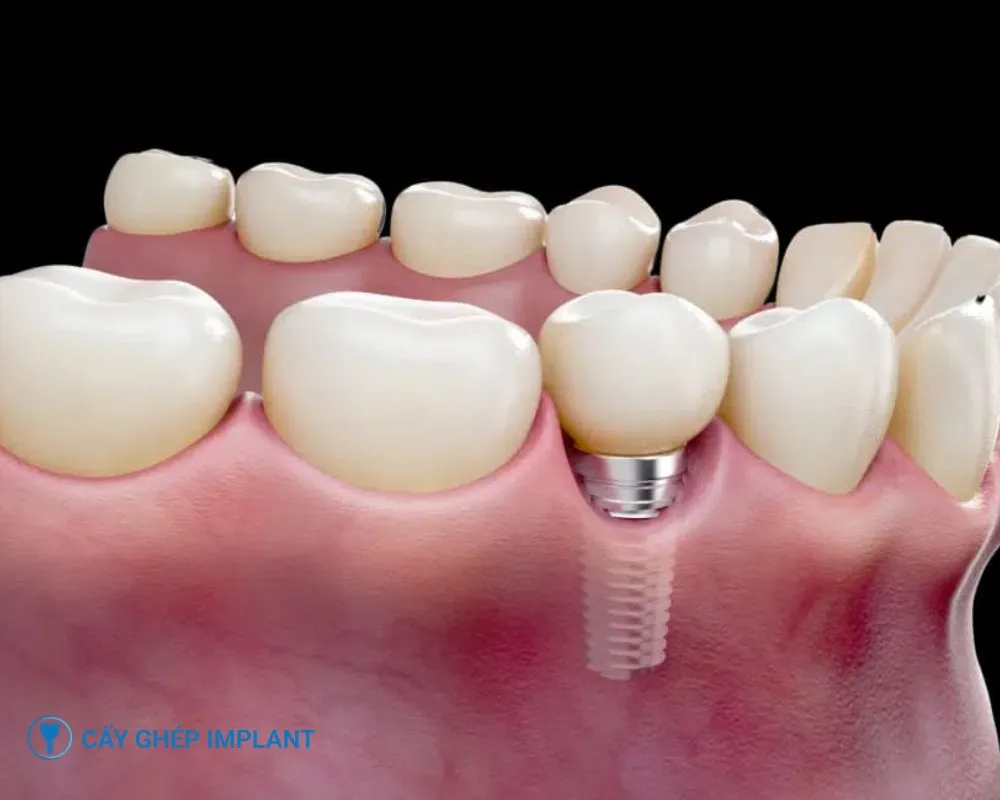 biến chứng khi trồng răng implant