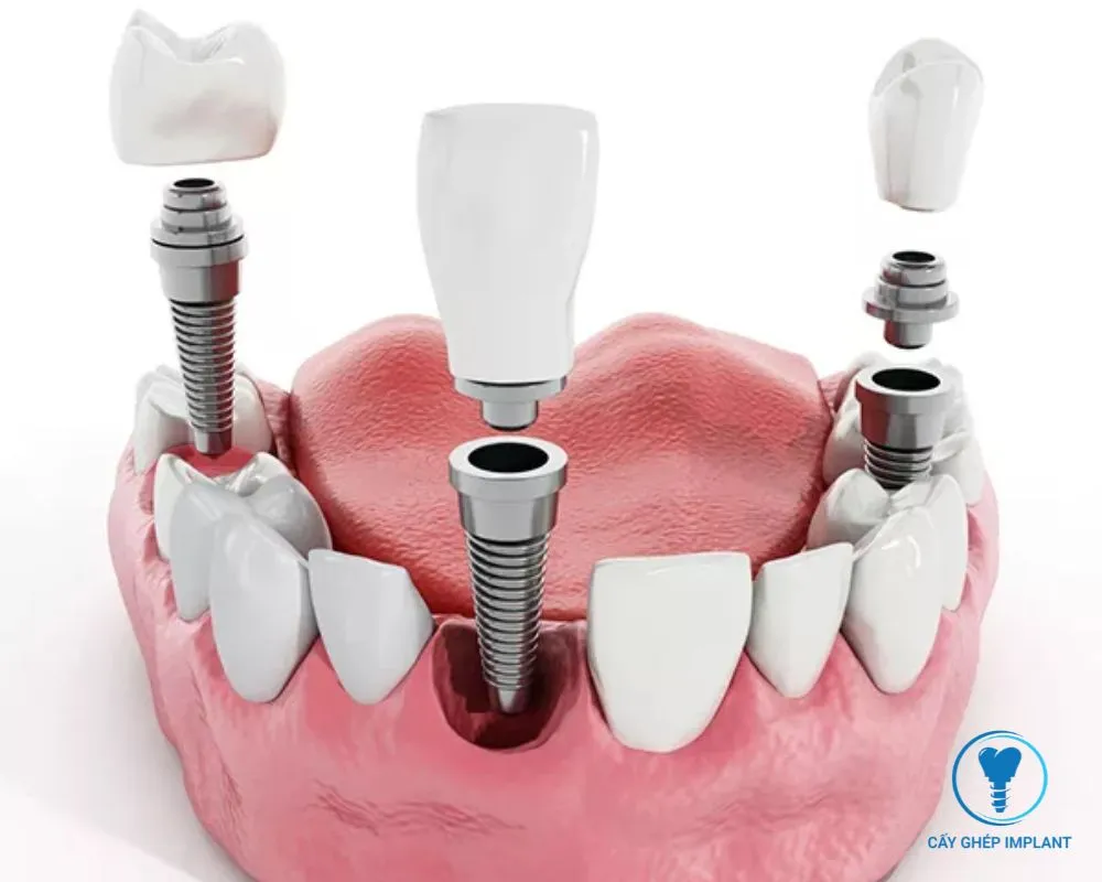 các giai đoạn cắm implant