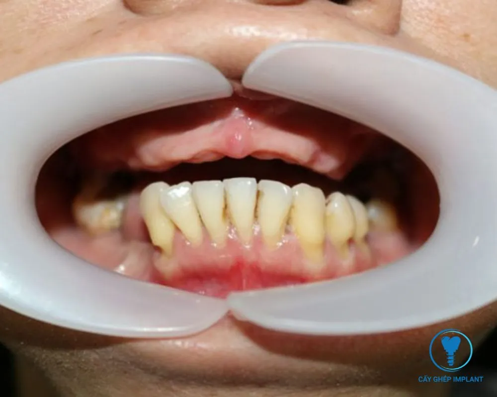 các giai đoạn cắm implant