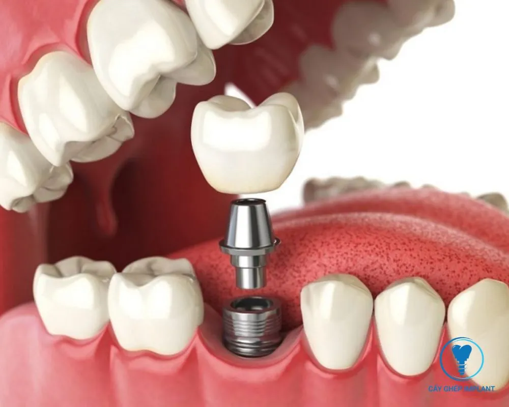 các giai đoạn cắm implant