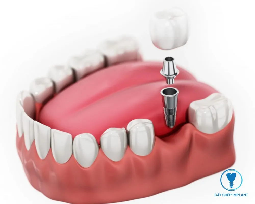 các giai đoạn cắm implant