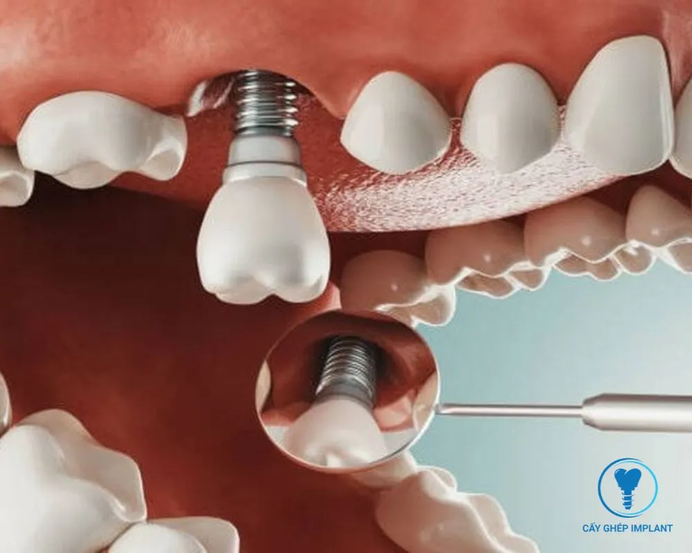 các giai đoạn cắm implant