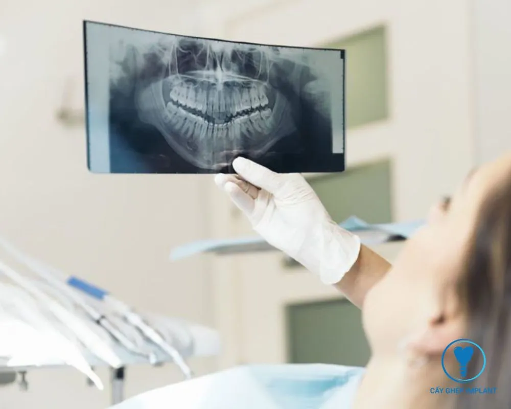 các giai đoạn cắm implant