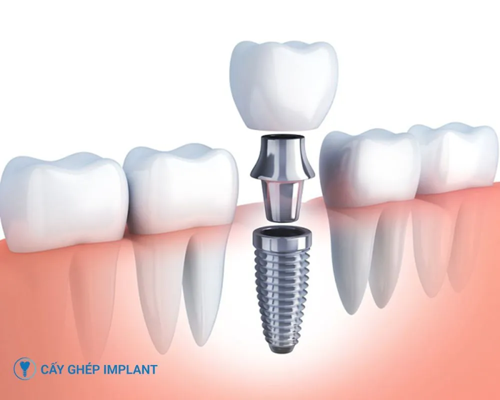 các loại trụ implant