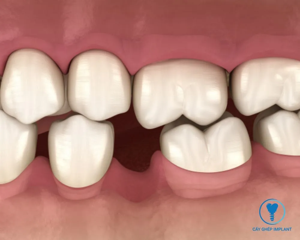 các loại trụ implant hàn quốc