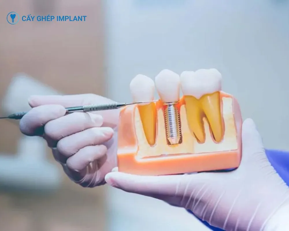cấy ghép implant trong nha khoa là gì