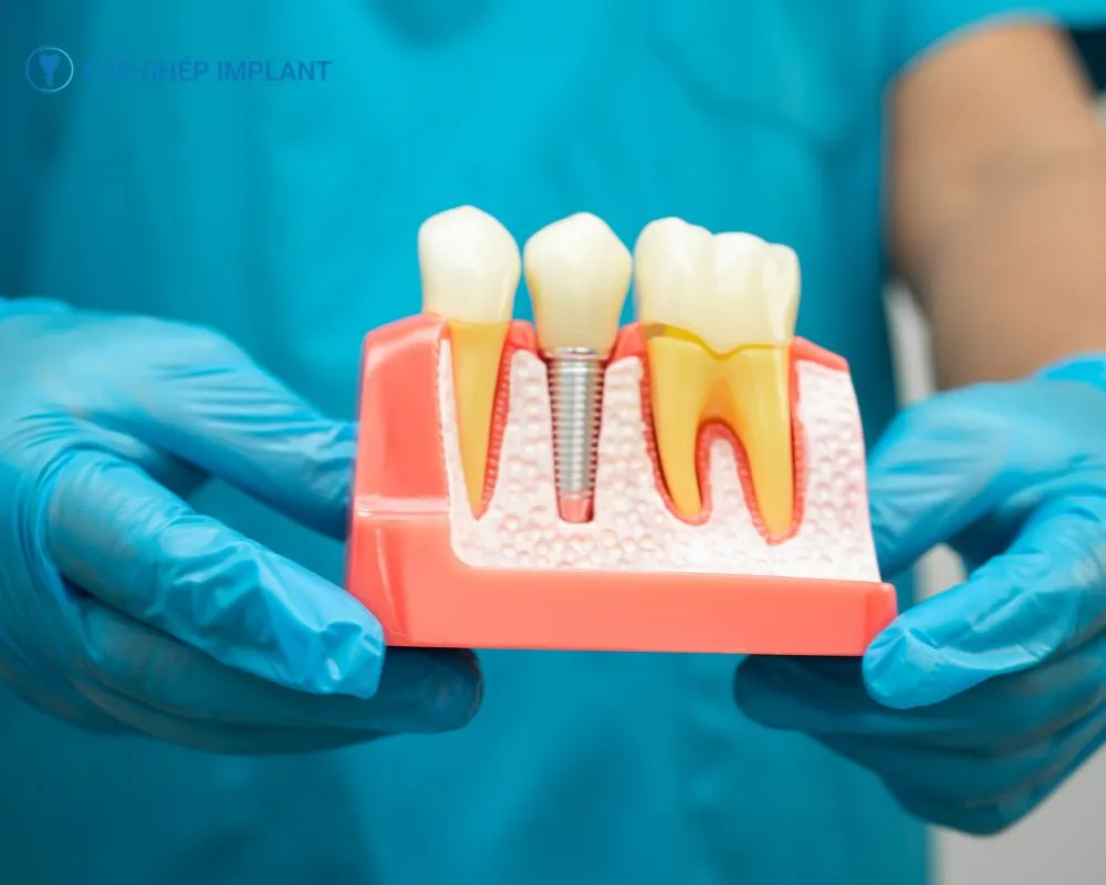cấy ghép implant trong nha khoa là gì