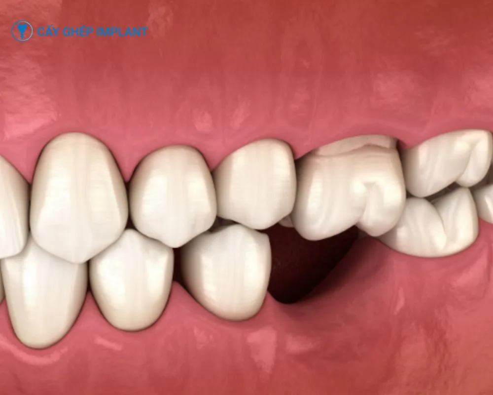 cấy ghép implant trong nha khoa là gì