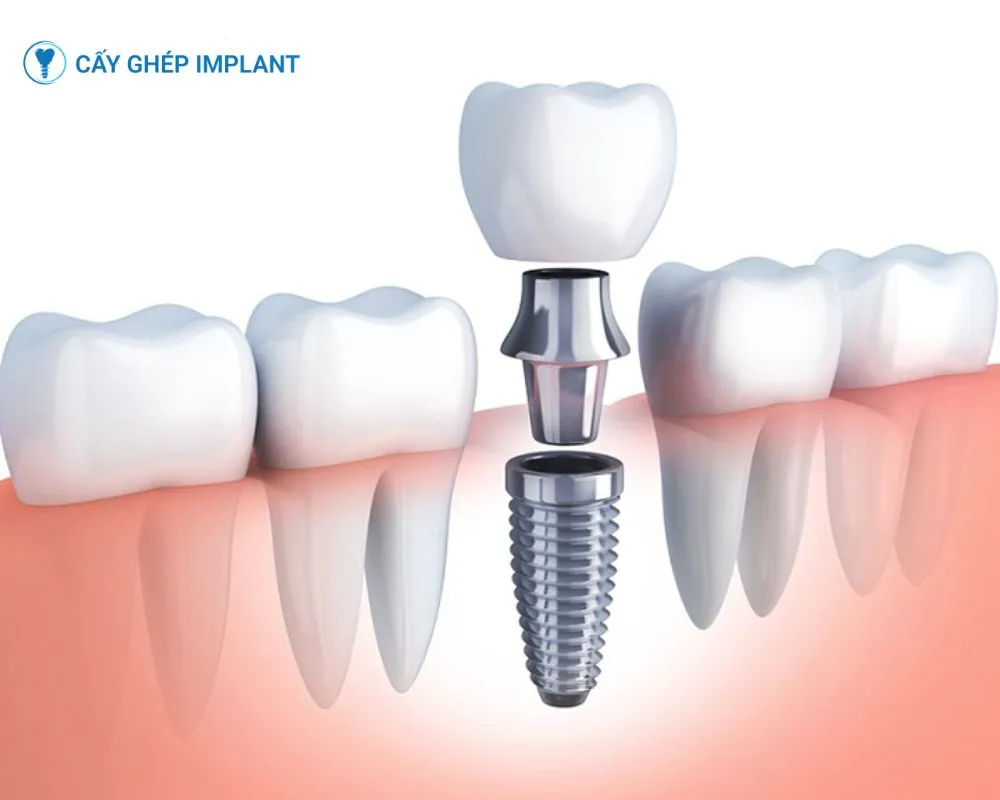 có nên trồng răng implant không