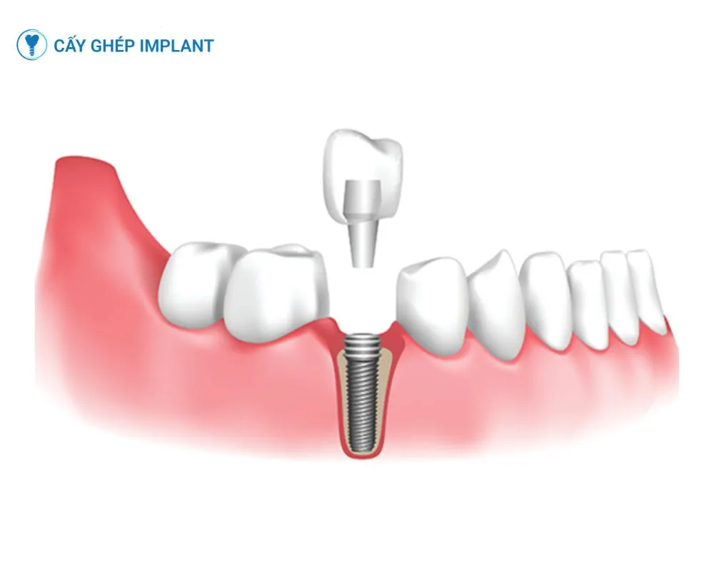 có nên trồng răng implant không