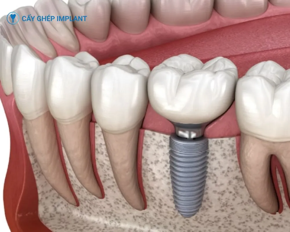 có nên trồng răng implant không