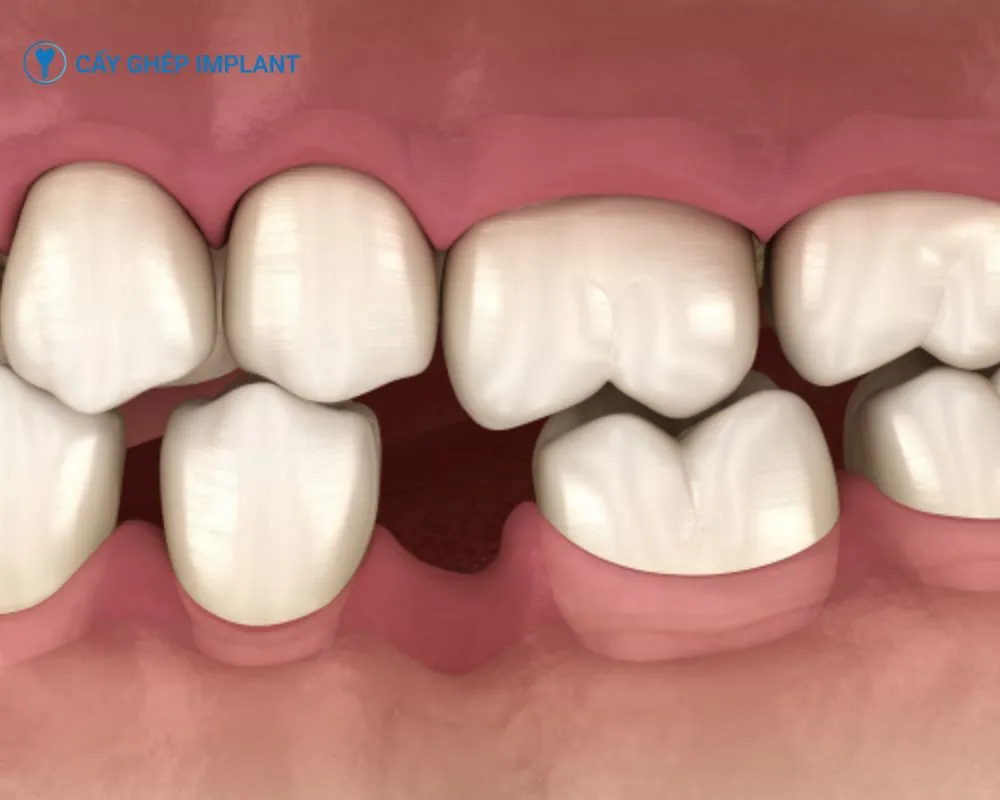 có nên trồng răng implant không