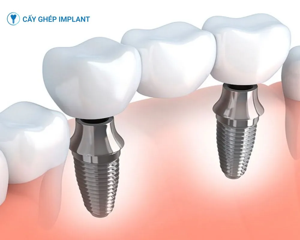 implant pháp