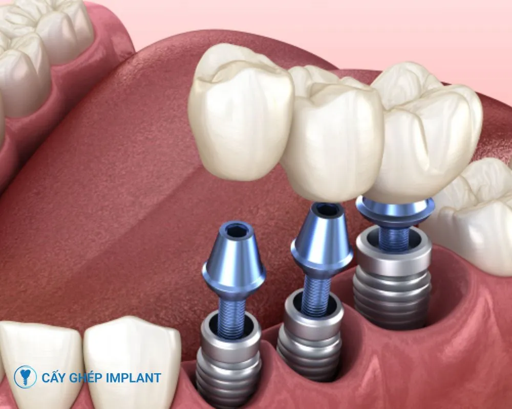 kinh nghiệm trồng răng implant