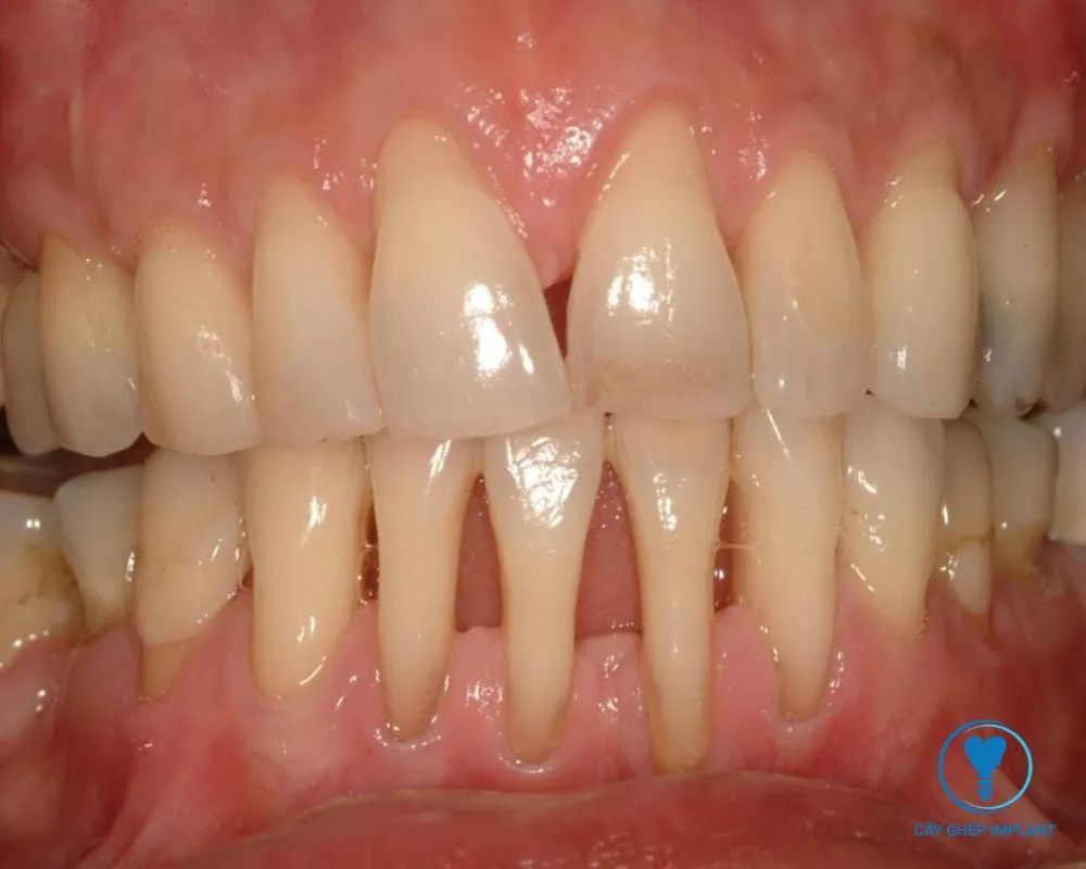 sau khi nhổ răng bao lâu thì trồng implant