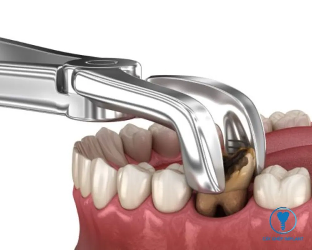 sau khi nhổ răng bao lâu thì trồng implant