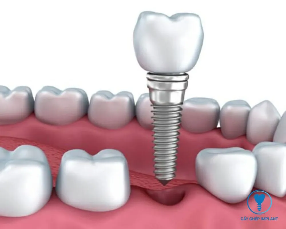 sau khi nhổ răng bao lâu thì trồng implant