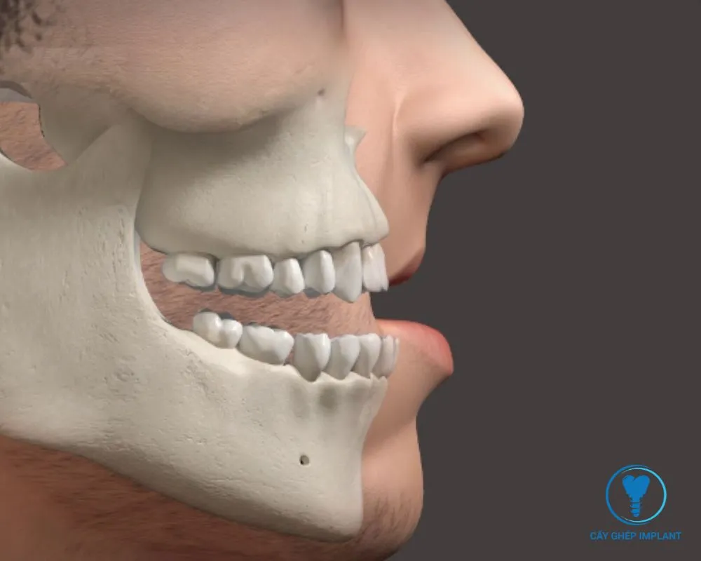 sau khi nhổ răng bao lâu thì trồng implant