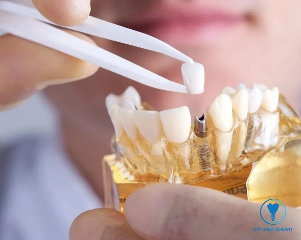sau khi nhổ răng bao lâu thì trồng implant