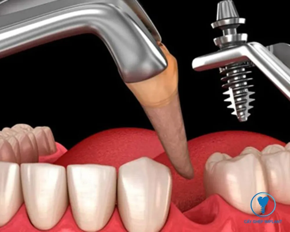 sau khi nhổ răng bao lâu thì trồng implant