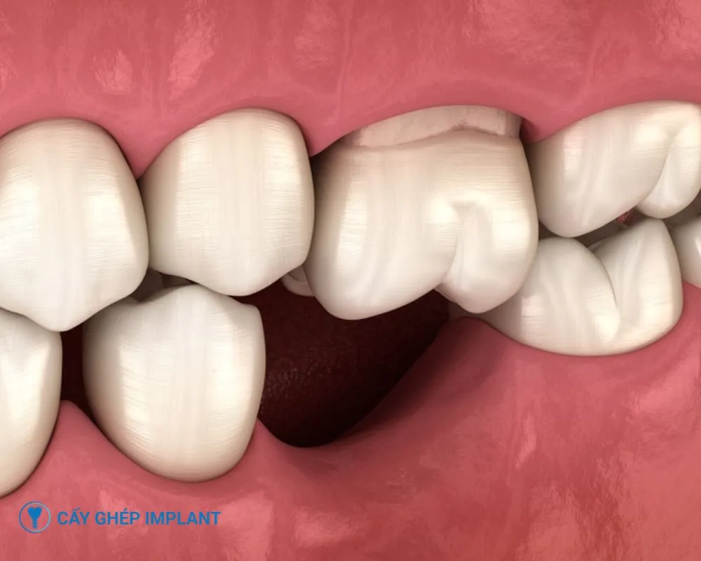 tác hại của việc trồng răng implant