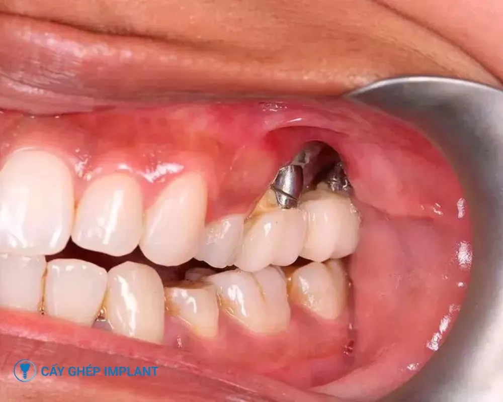 tác hại của việc trồng răng implant