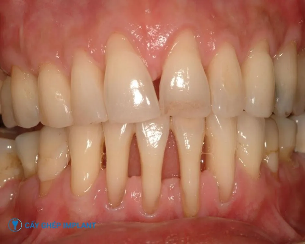 tác hại của việc trồng răng implant