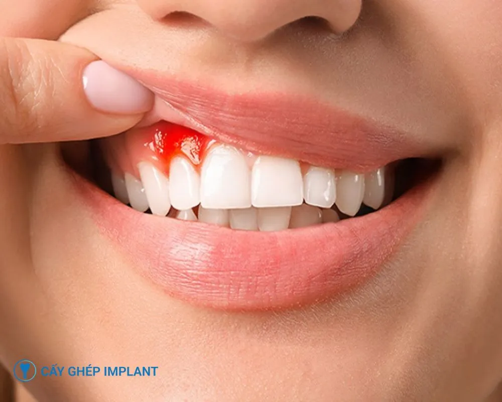 tác hại của việc trồng răng implant