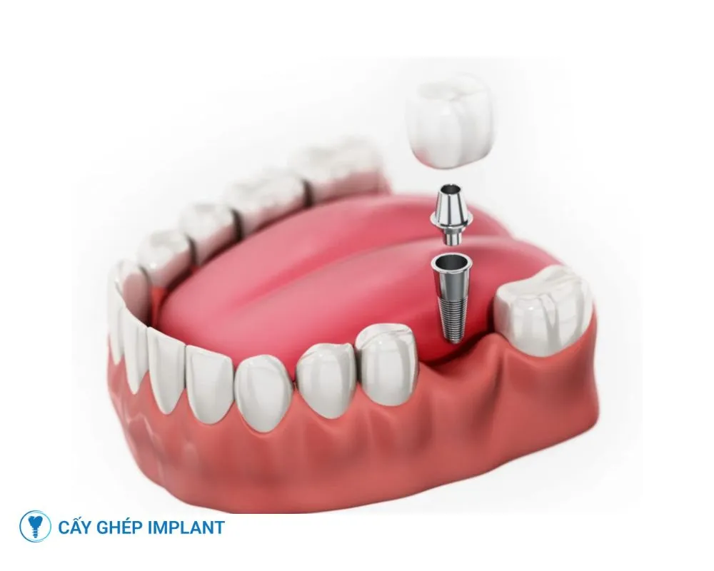 tiểu đường có trồng răng implant được không