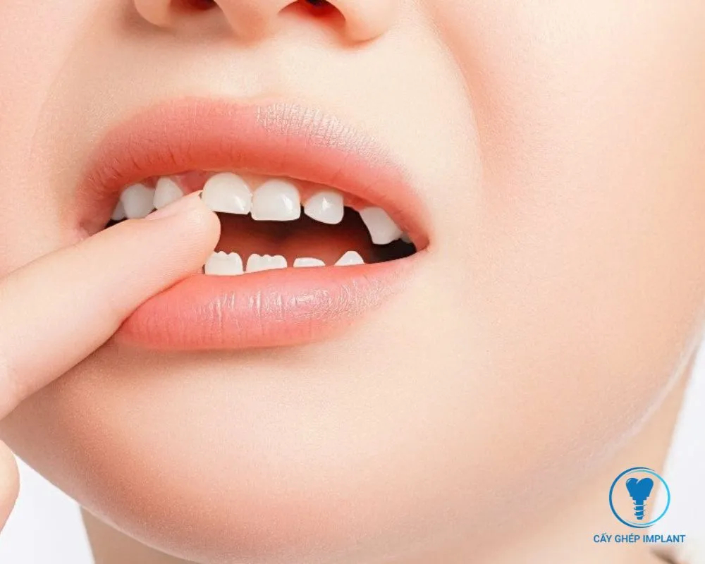 trẻ em có trồng răng implant được không