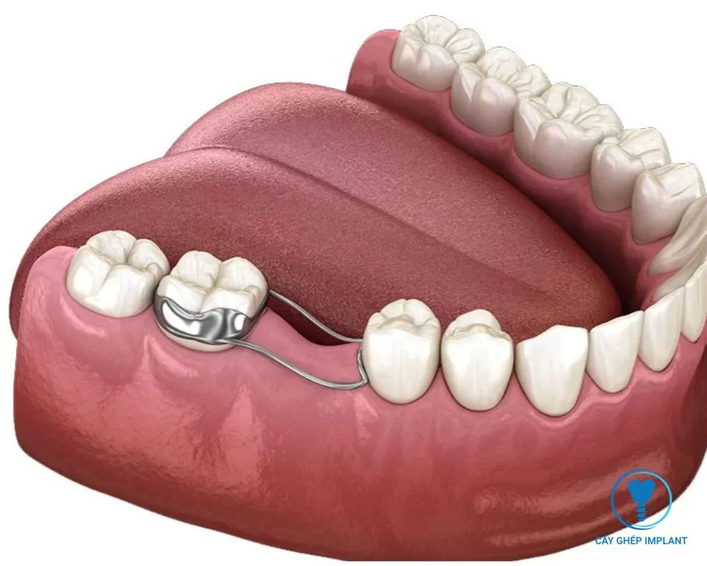 trẻ em có trồng răng implant được không