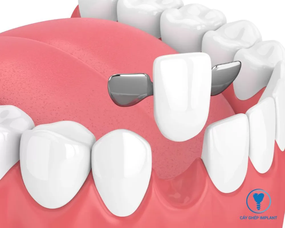 trẻ em có trồng răng implant được không