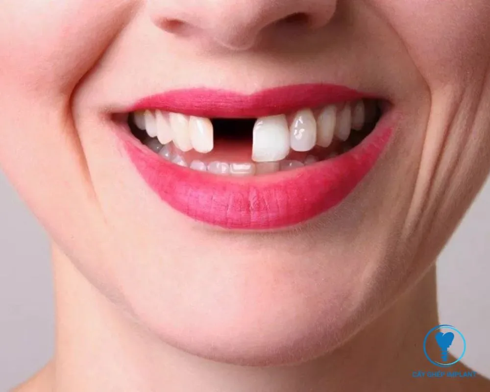 trồng implant răng cửa