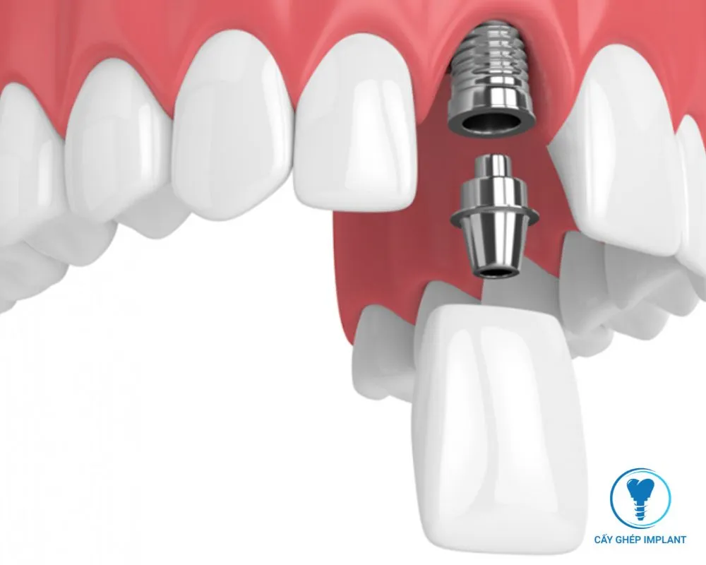 trồng implant răng cửa