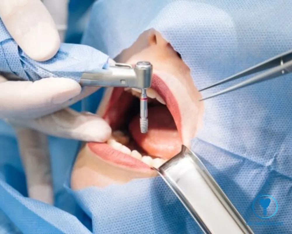 trồng implant răng cửa