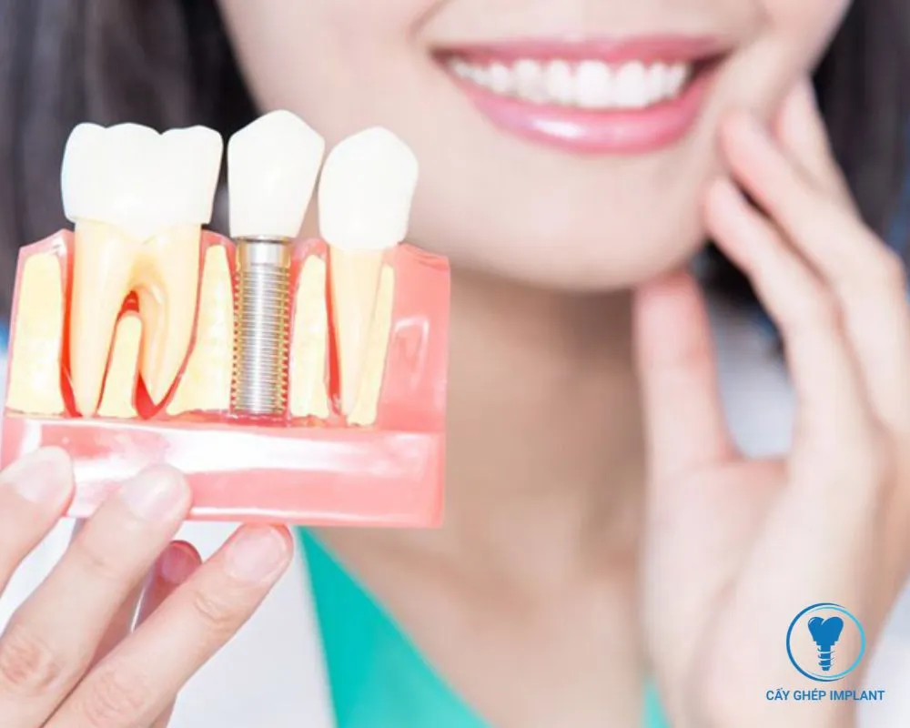 trồng implant răng cửa