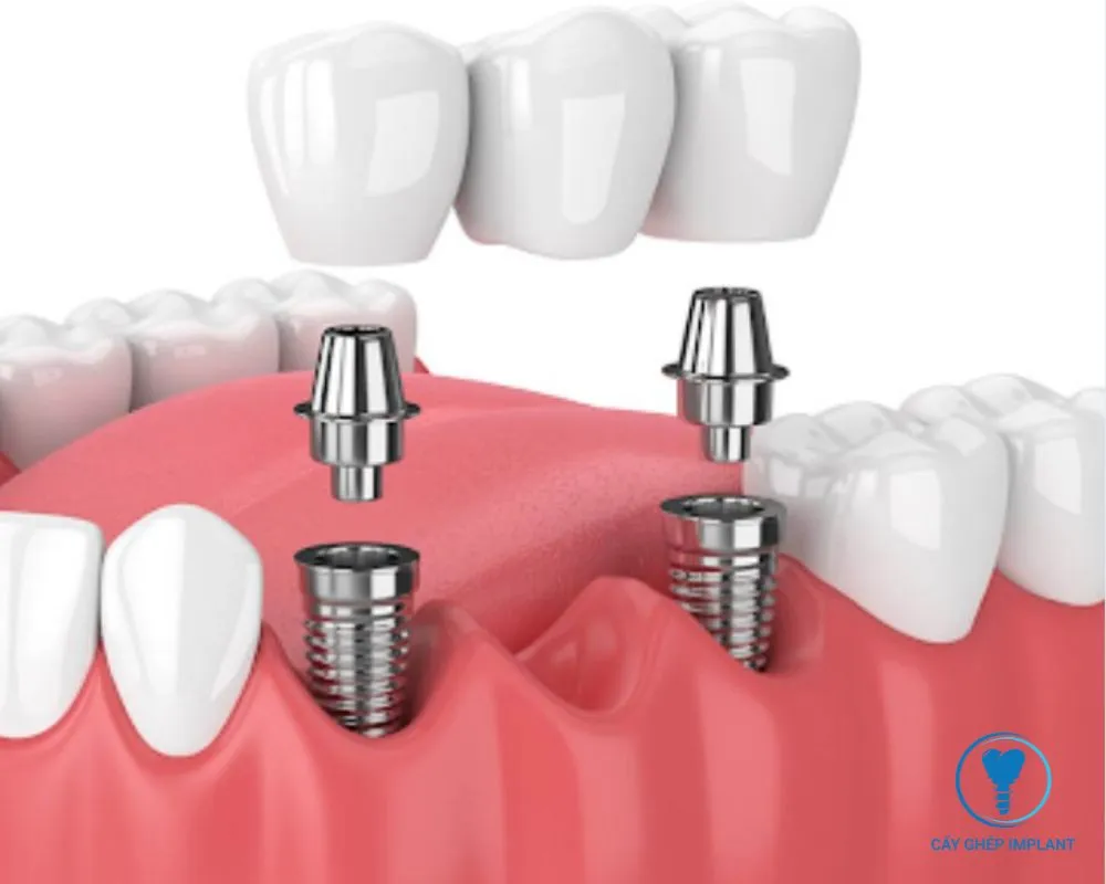 trồng răng bằng phương pháp implant