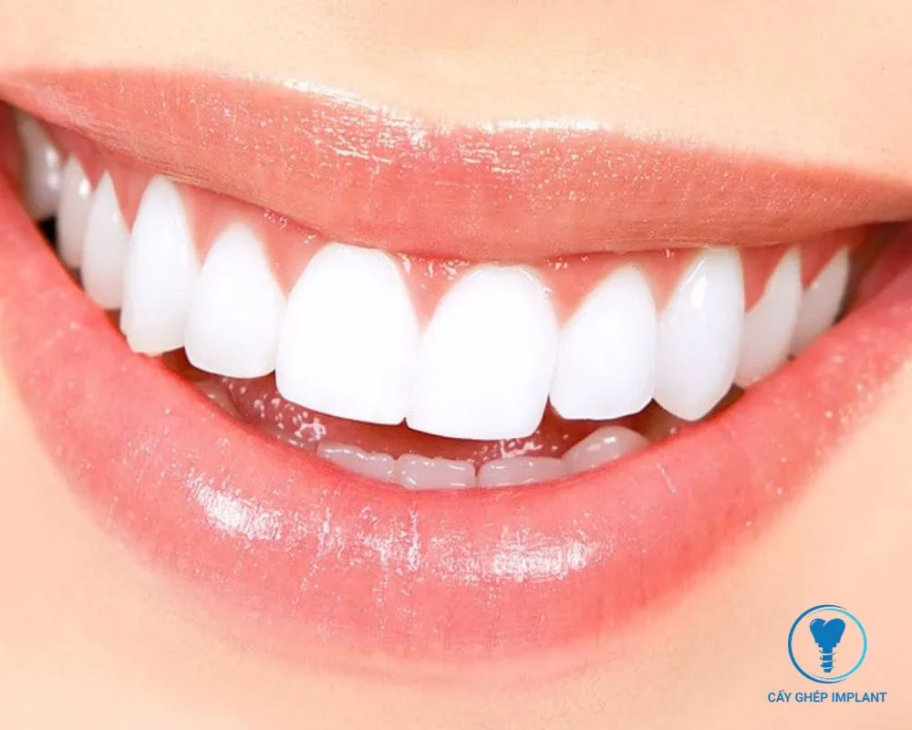 trồng răng bằng phương pháp implant