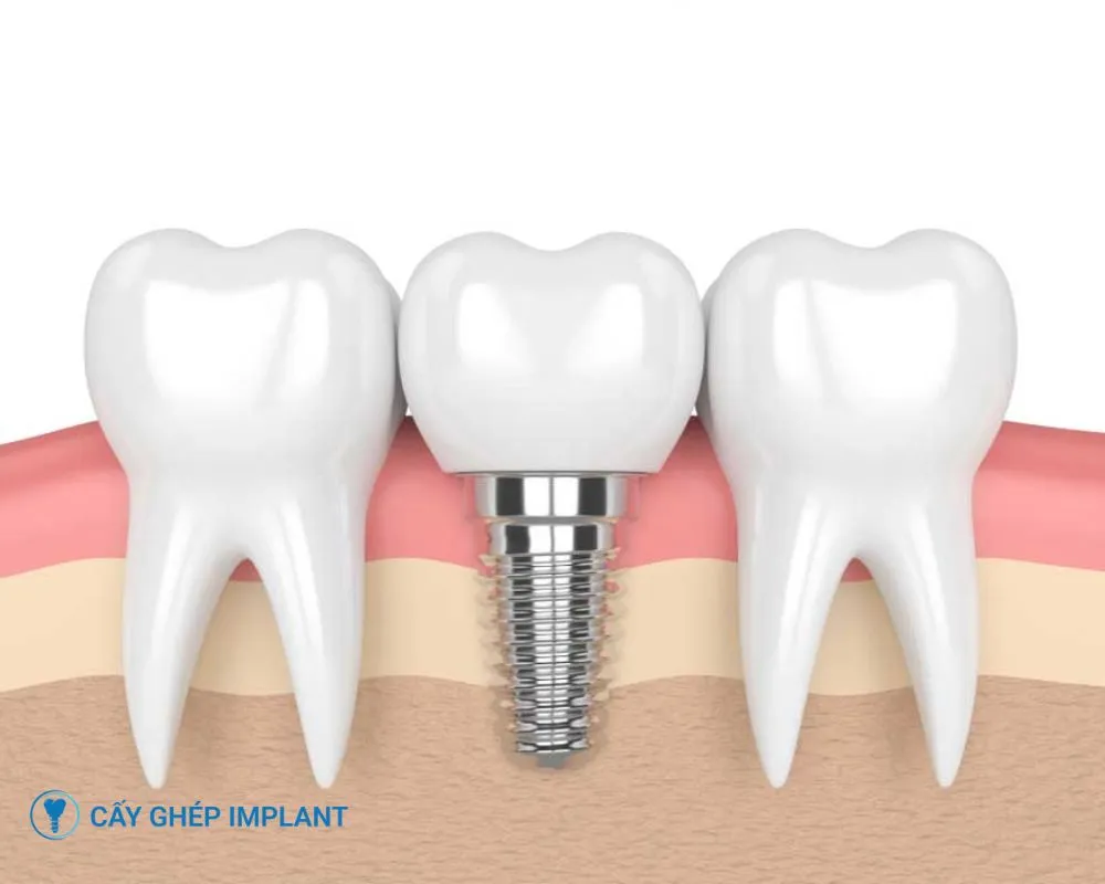 trồng răng implant bao lâu thì lành