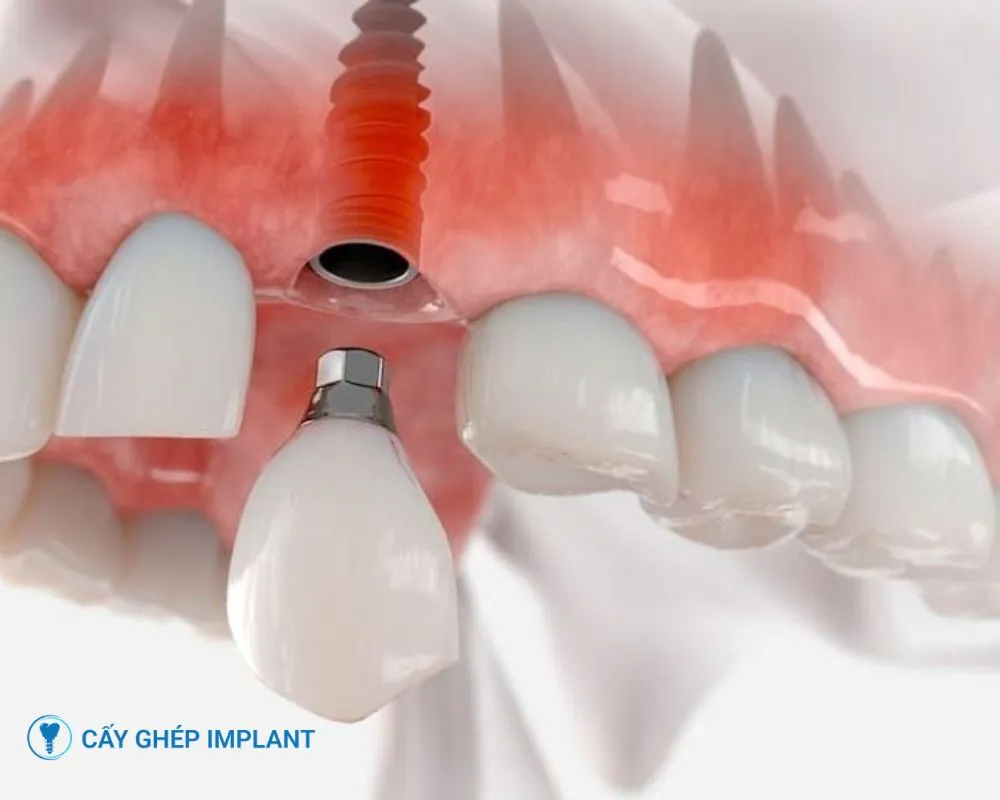 trồng răng implant bao lâu thì lành