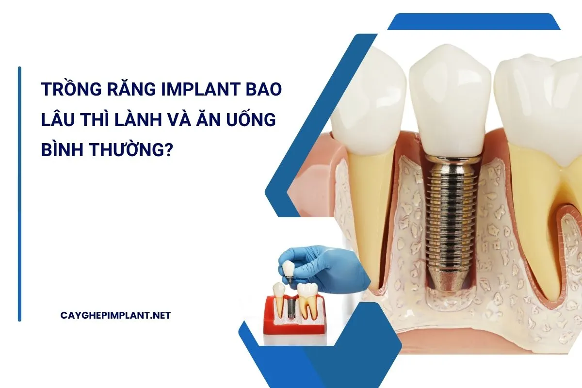 trồng răng implant bao lâu thì lành