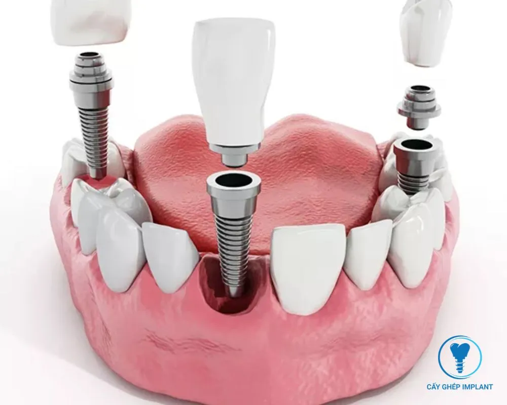 trồng răng implant có được bảo hiểm không
