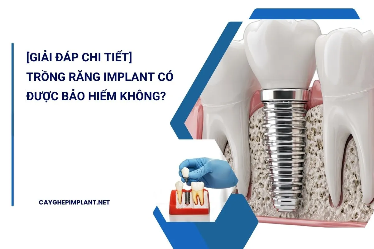 trồng răng implant có được bảo hiểm không