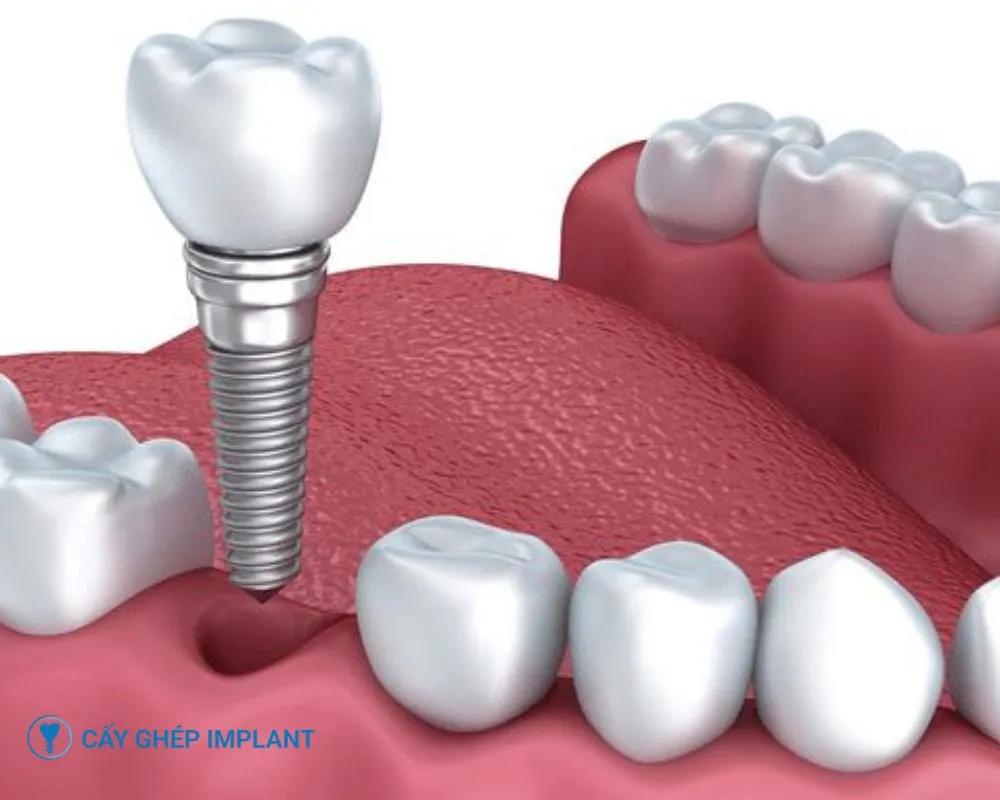 trồng răng implant có niềng răng được không