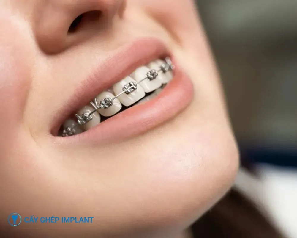 trồng răng implant có niềng răng được không