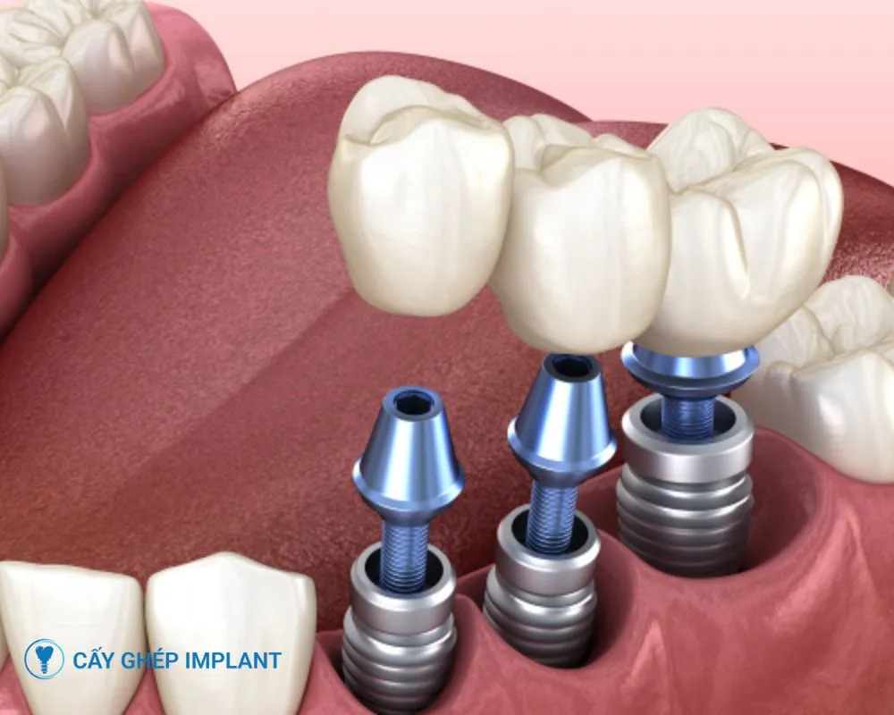 trồng răng implant có niềng răng được không